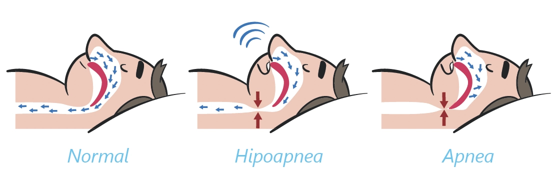 Tipos de apnea